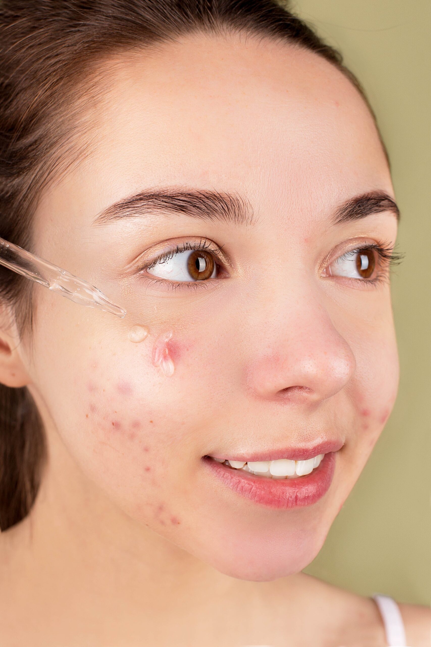 Causes and Treatment of Acne