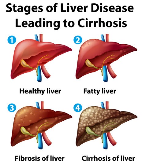 Stages of Liver Disease