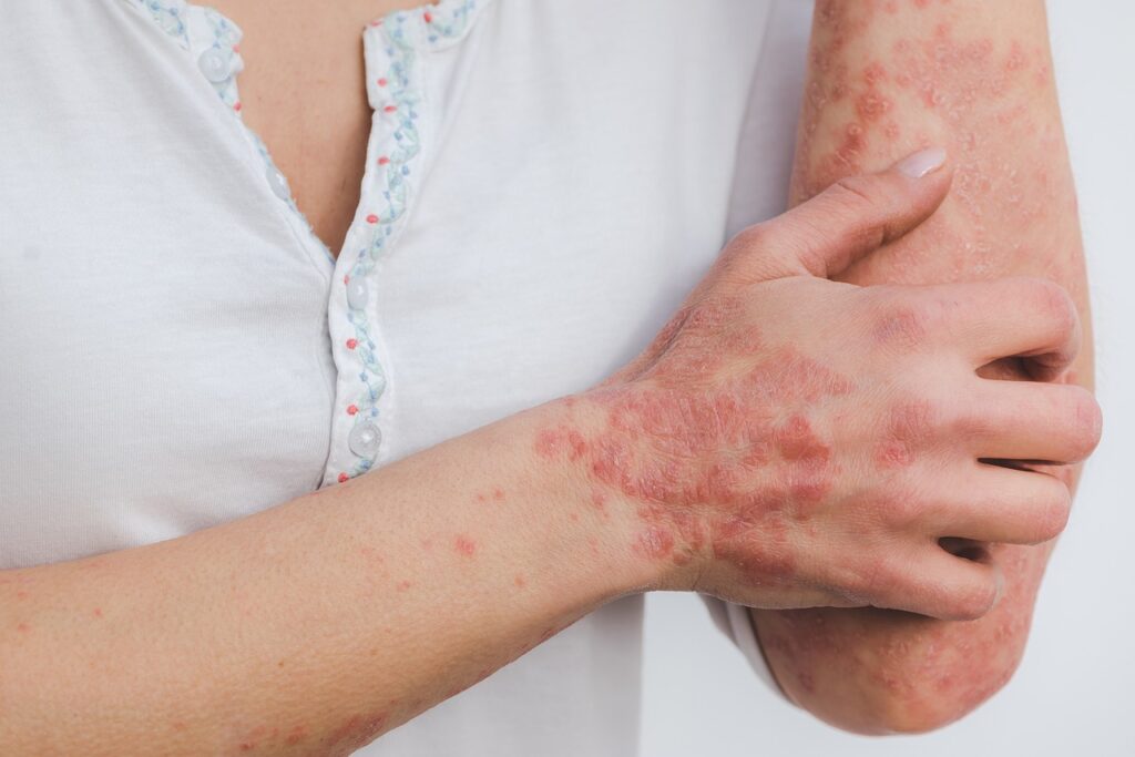 Understanding Psoriasis: Causes, Treatment, Management, and Prevention