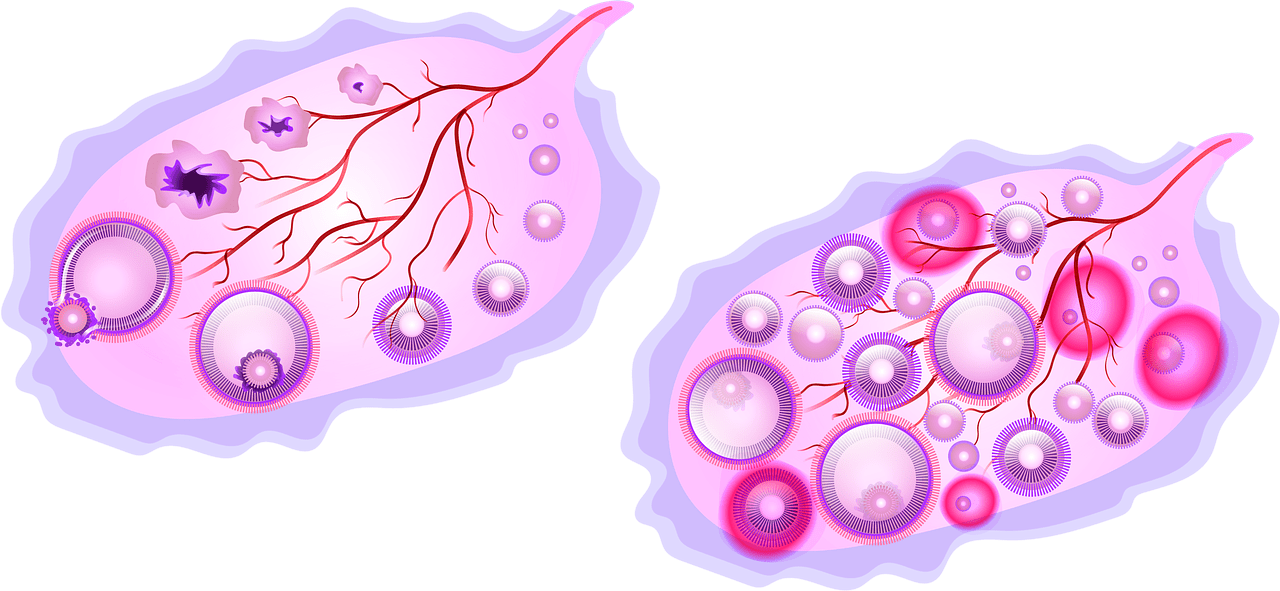 What Is Polycystic Kidney Disease